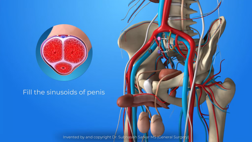 Erectile-Dysfunction-Treatment-3D-Medical-Animation