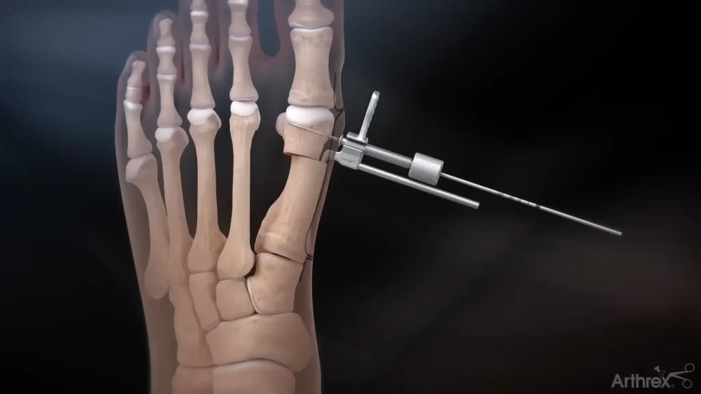 Arthrex-Minimally-Invasive-Bunion-Surgery-Case-Study-2