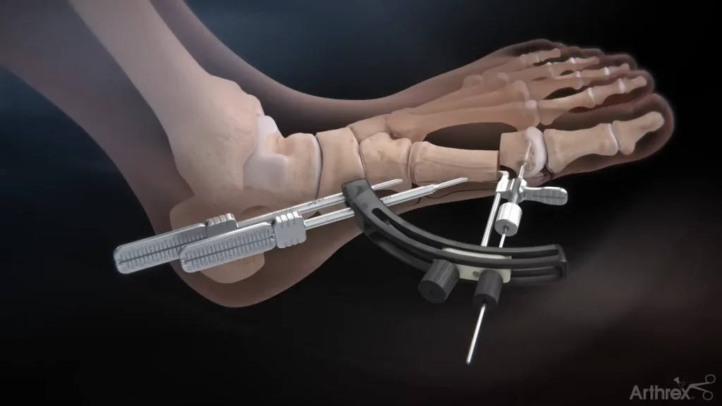 Arthrex-Minimally-Invasive-Bunion-Surgery-Case-Study-3