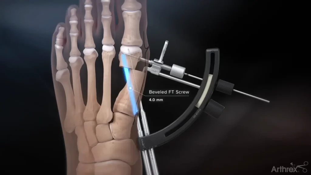 Arthrex-Minimally-Invasive-Bunion-Surgery-Case-Study-4