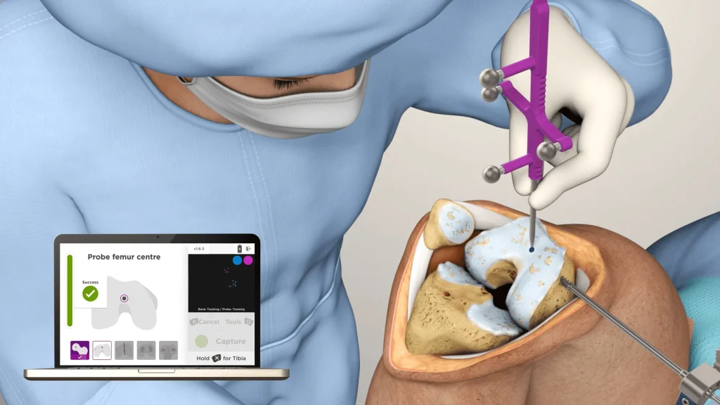 total-knee-replacement-surgery-1