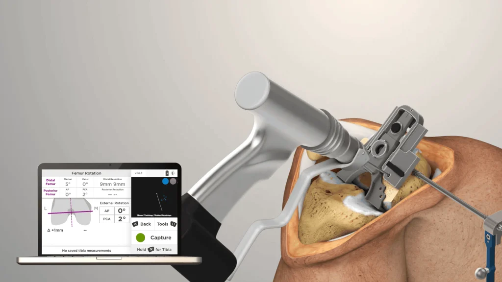total-knee-replacement-surgery-2