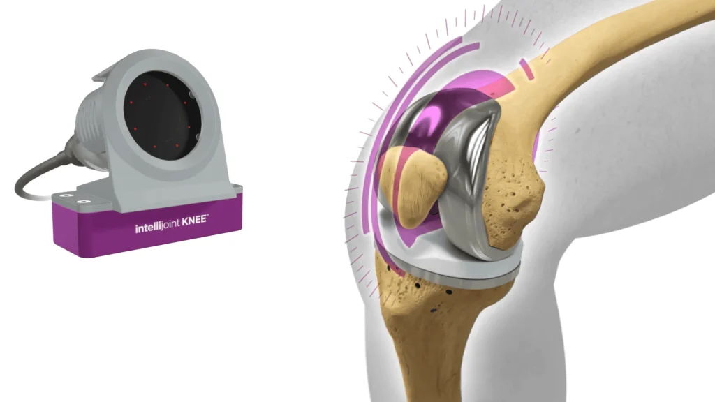 total-knee-replacement-surgery